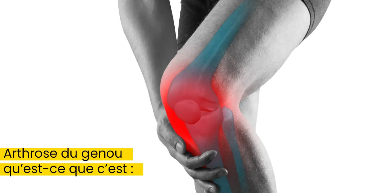 Arthrose du genou qu’est-ce que c’est :